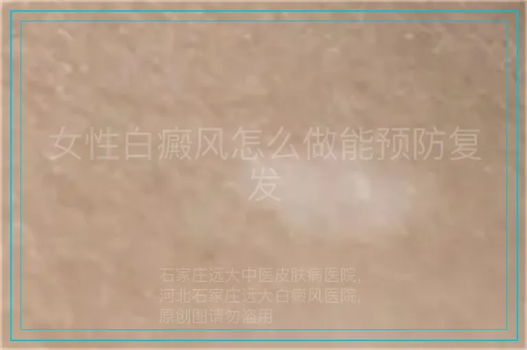女性白癜风怎么做能预防复发