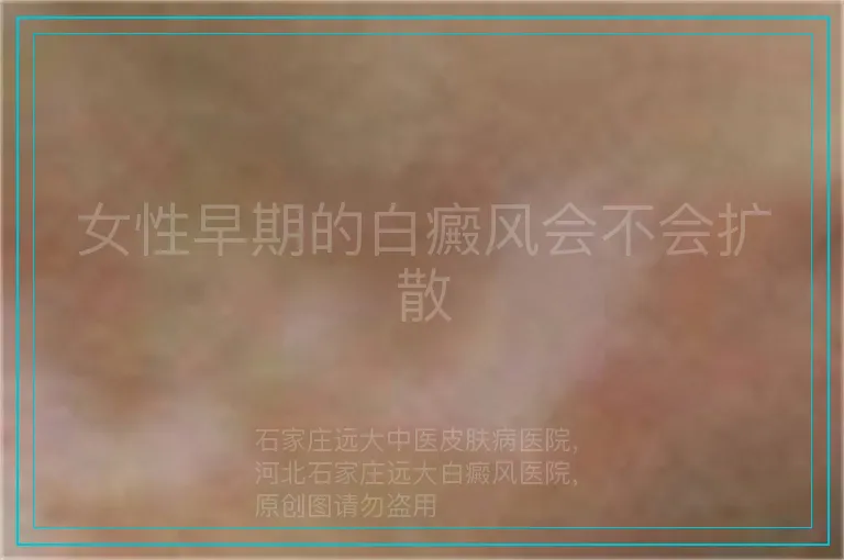 女性早期的白癜风会不会扩散