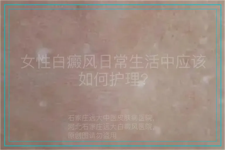 女性白癜风日常生活中应该如何护理?