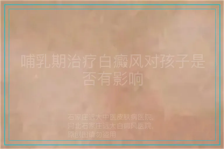 哺乳期治疗白癜风对孩子是否有影响