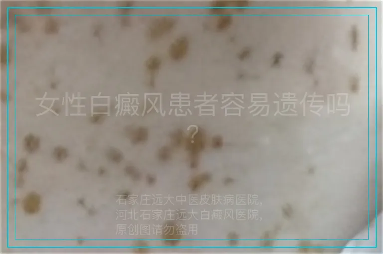 女性白癜风患者容易遗传吗?