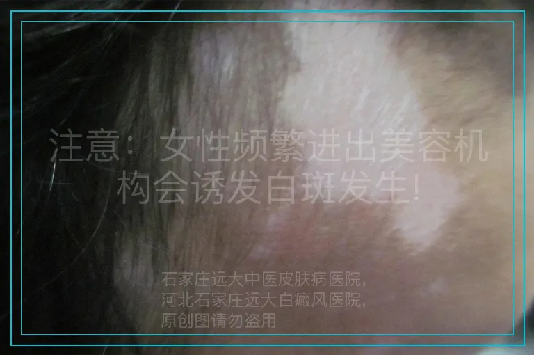 注意：女性频繁进出美容机构会诱发白斑发生!
