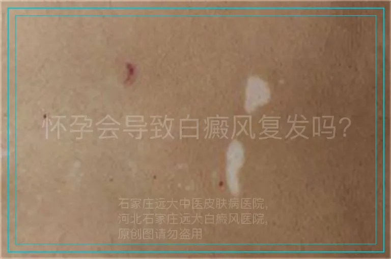 怀孕会导致白癜风复发吗?