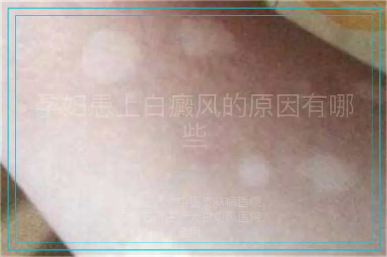 孕妇患上白癜风的原因有哪些