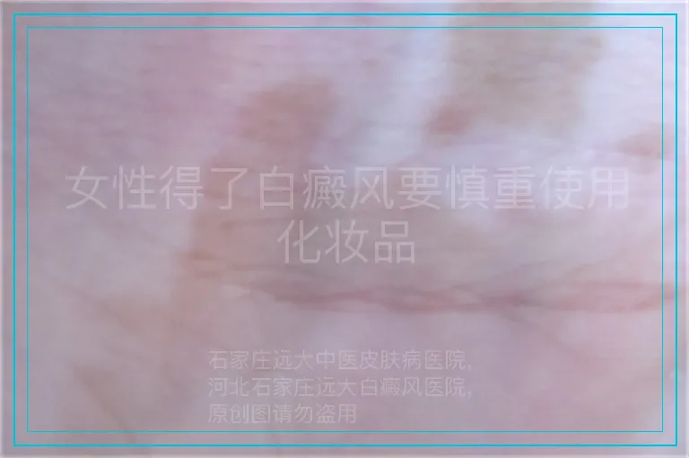 女性得了白癜风要慎重使用化妆品