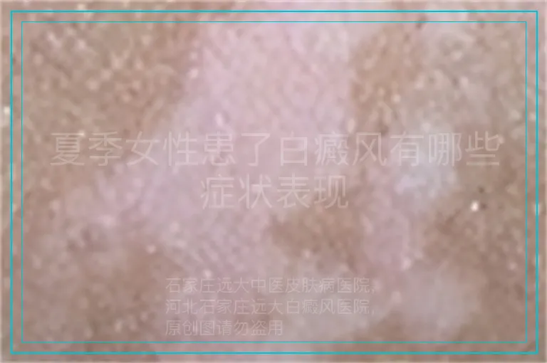 夏季女性患了白癜风有哪些症状表现