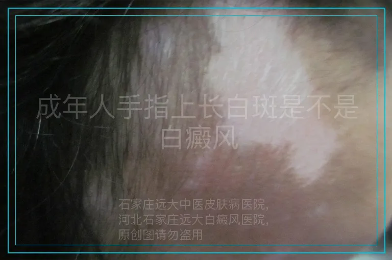 成年人手指上长白斑是不是白癜风