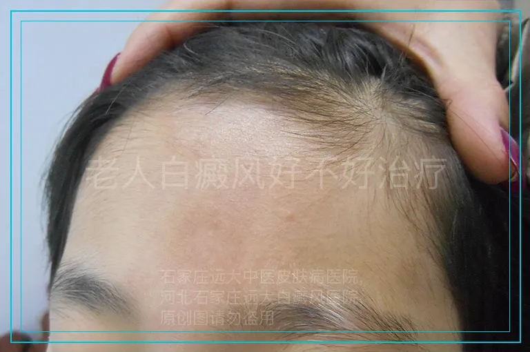 老人白癜风好不好治疗