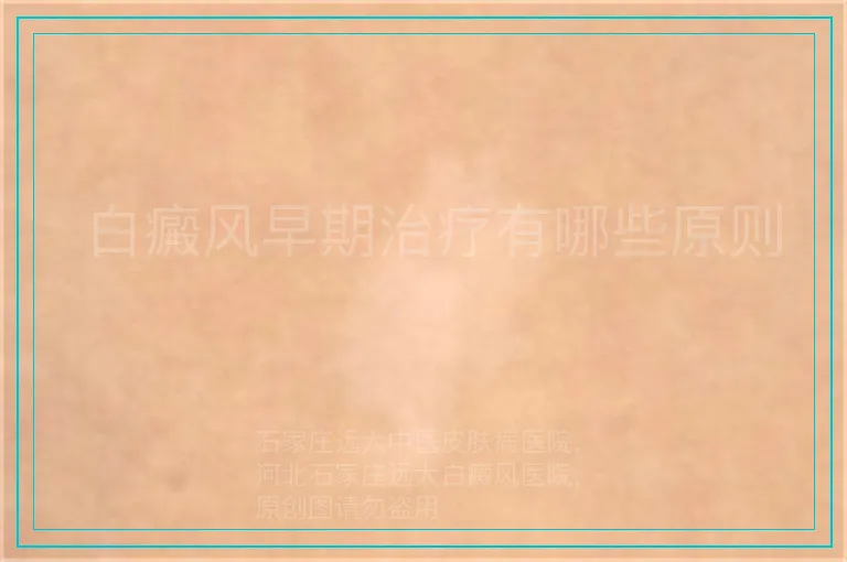  白癜风早期治疗有哪些原则