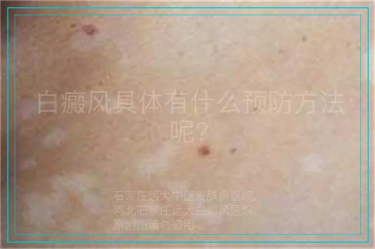 白癜风具体有什么预防方法呢?