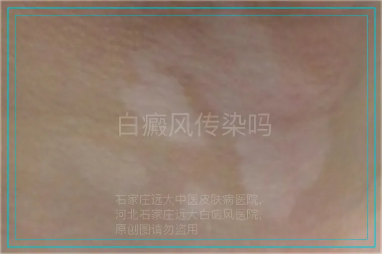 白癜风传染吗