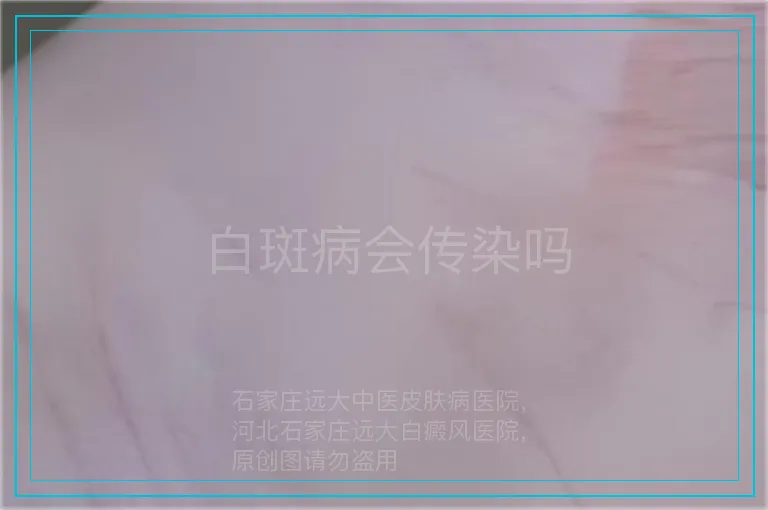 白斑病会传染吗