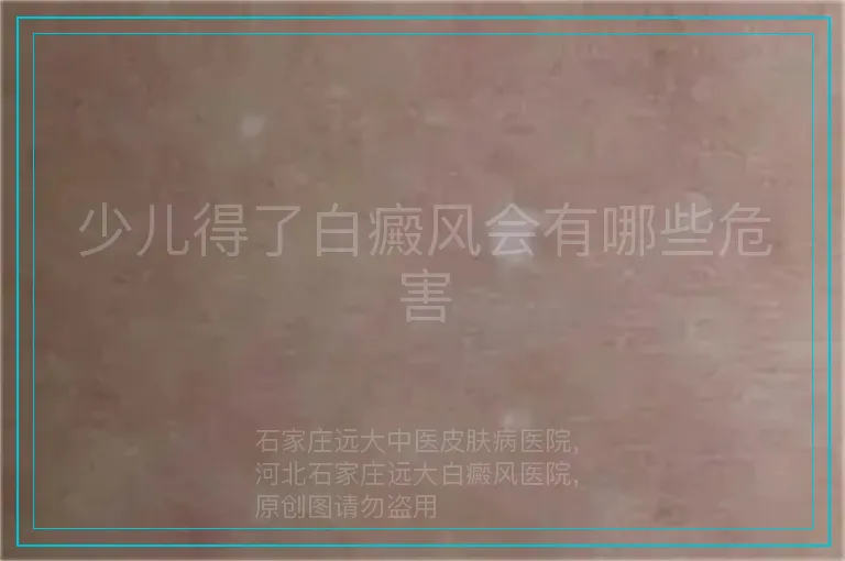 少儿得了白癜风会有哪些危害
