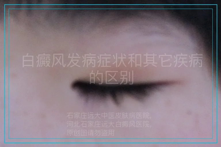 白癜风发病症状和其它疾病的区别