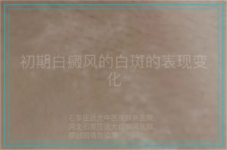 初期白癜风的白斑的表现变化