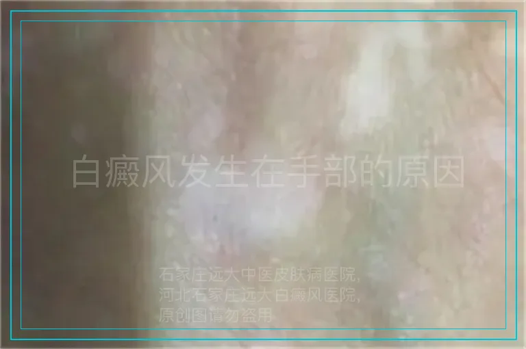 白癜风发生在手部的原因