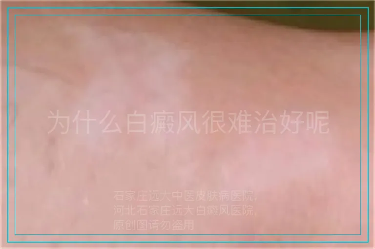 为什么白癜风很难治好呢