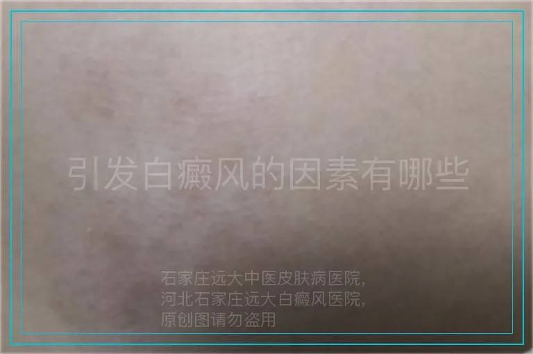 引发白癜风的因素有哪些