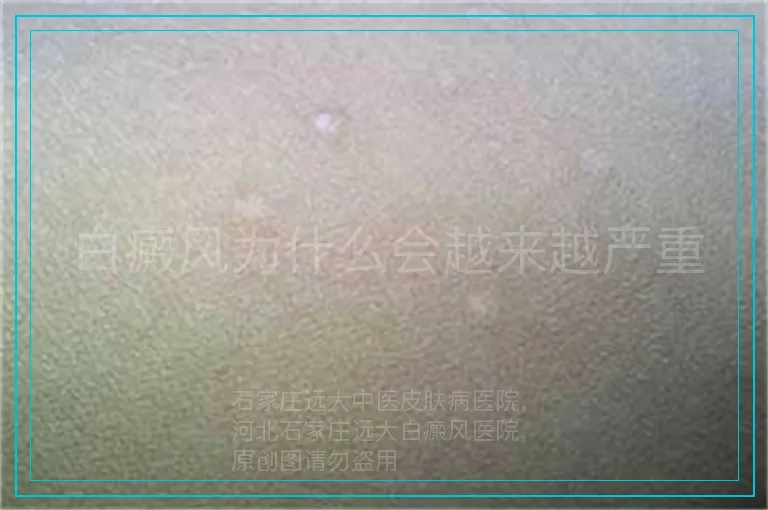白癜风为什么会越来越严重