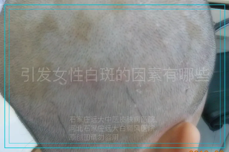 引发女性白斑的因素有哪些