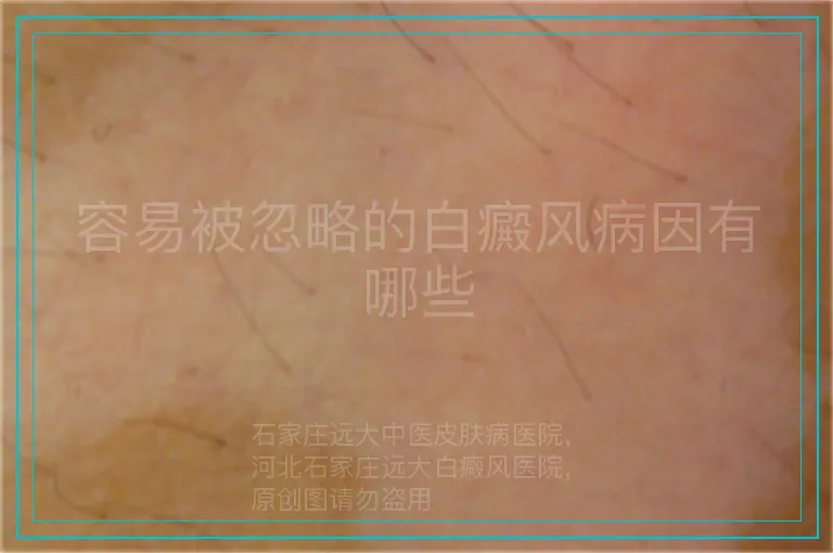 容易被忽略的白癜风病因有哪些
