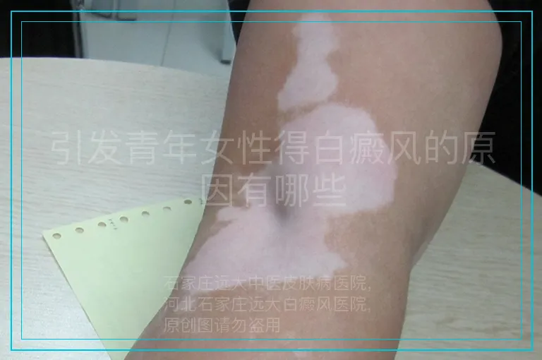 引发青年女性得白癜风的原因有哪些