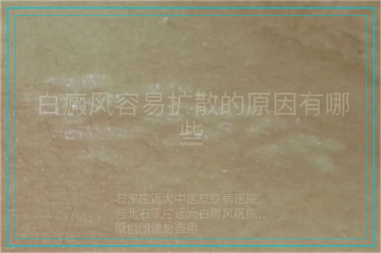 白癜风容易扩散的原因有哪些