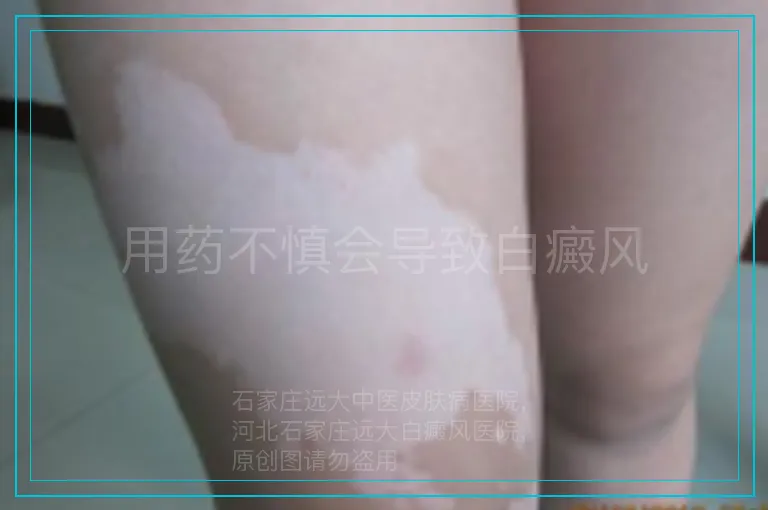 用药不慎会导致白癜风