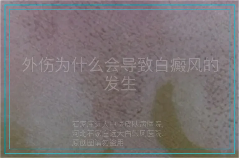外伤为什么会导致白癜风的发生