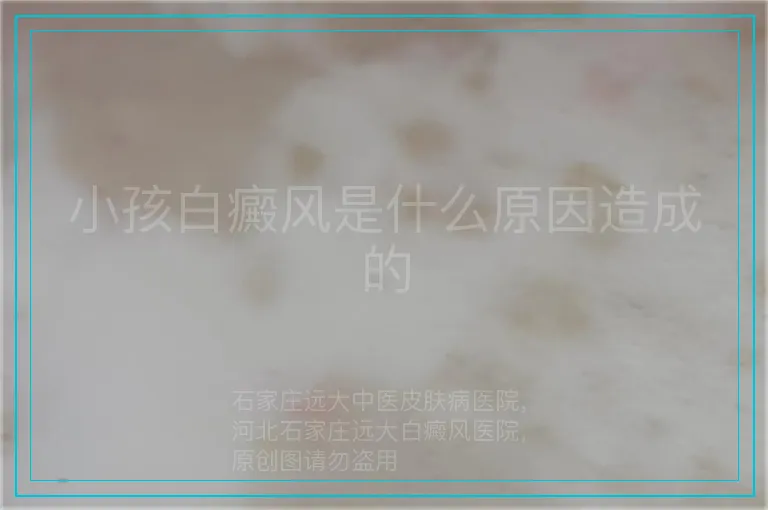 小孩白癜风是什么原因造成的