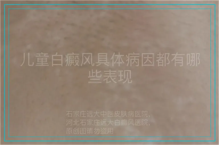 儿童白癜风具体病因都有哪些表现