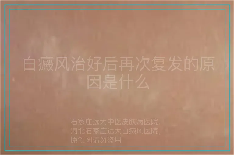 白癜风治好后再次复发的原因是什么