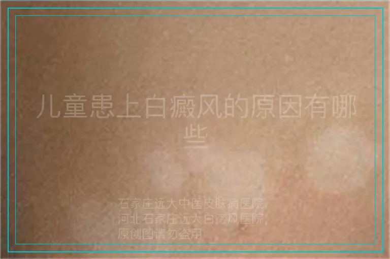 儿童患上白癜风的原因有哪些