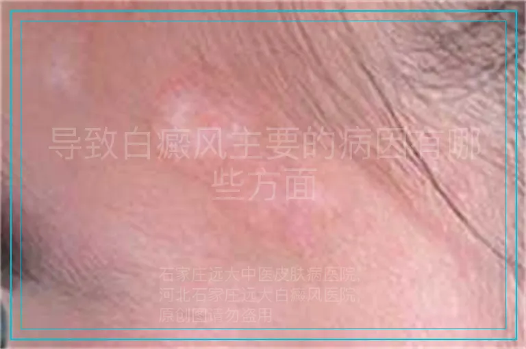 导致白癜风主要的病因有哪些方面