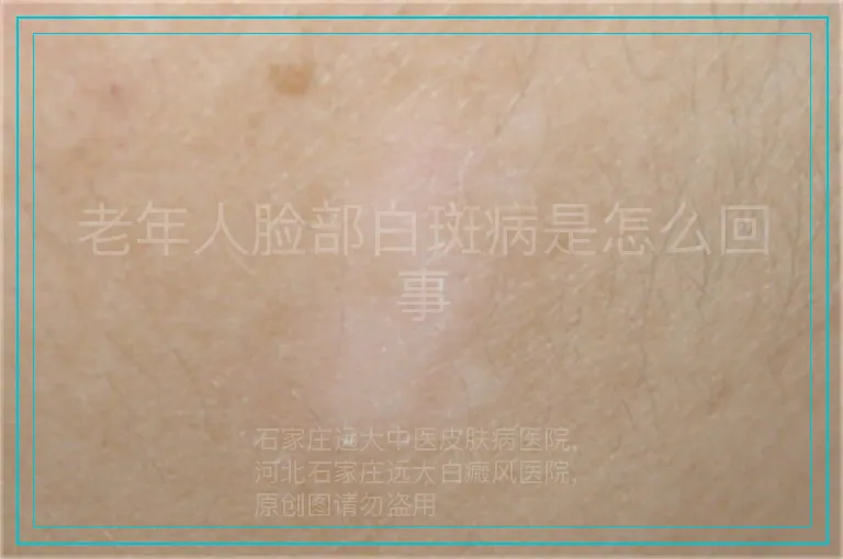 老年人脸部白斑病是怎么回事