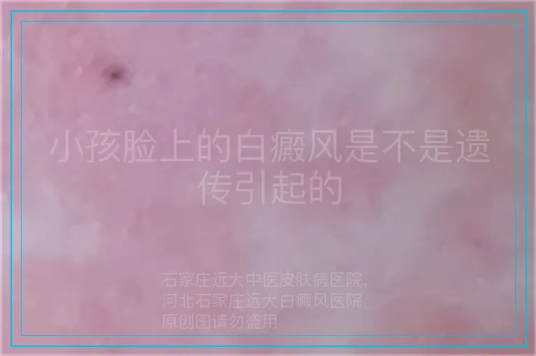 小孩脸上的白癜风是不是遗传引起的