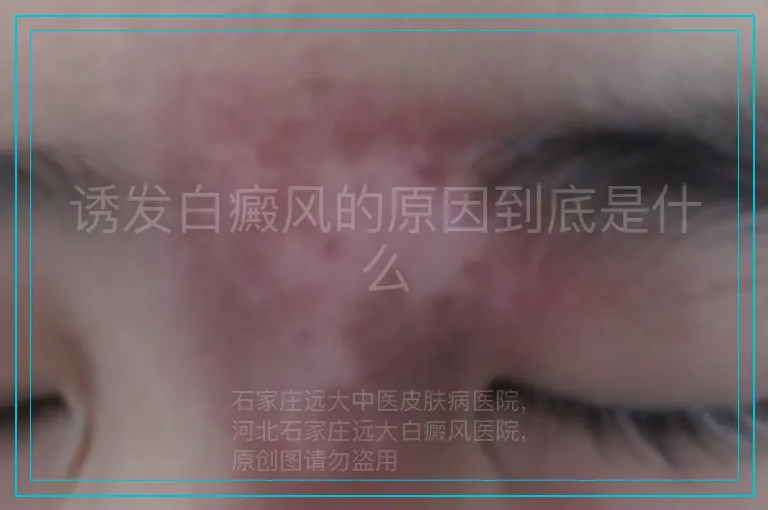 诱发白癜风的原因到底是什么