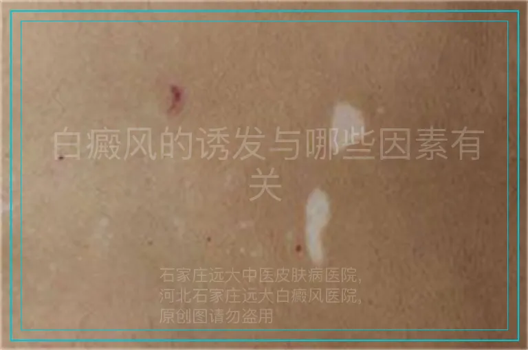 白癜风的诱发与哪些因素有关