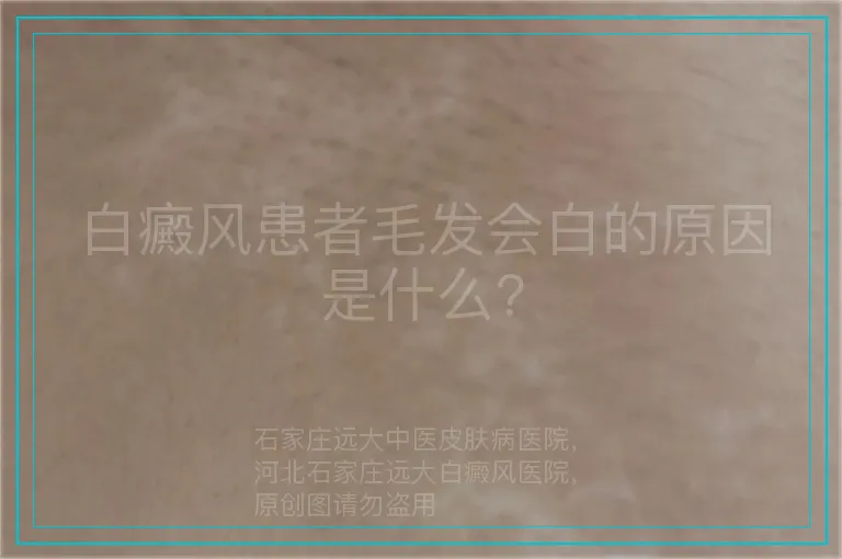白癜风患者毛发会白的原因是什么?