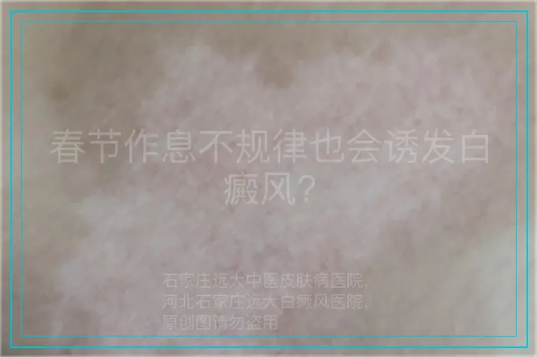 春节作息不规律也会诱发白癜风?