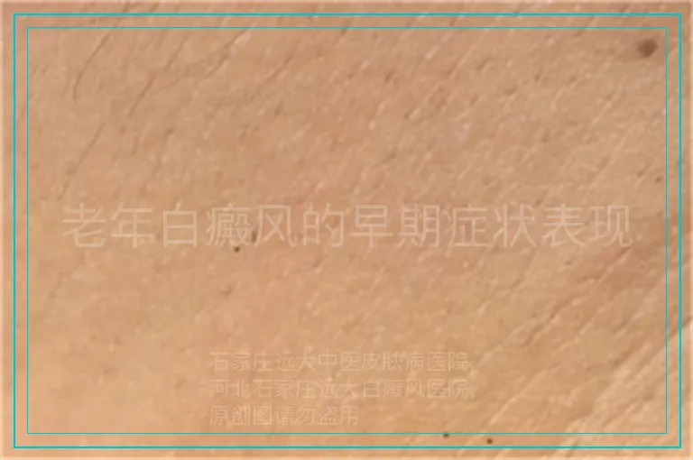 老年白癜风的早期症状表现