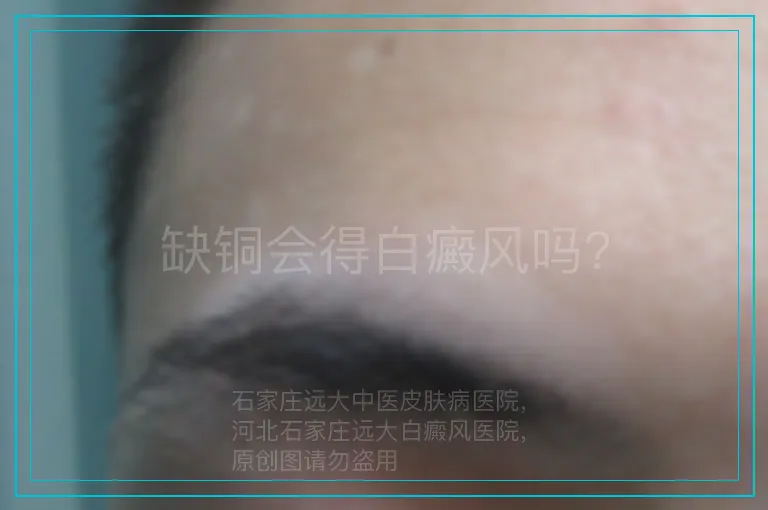 缺铜会得白癜风吗?