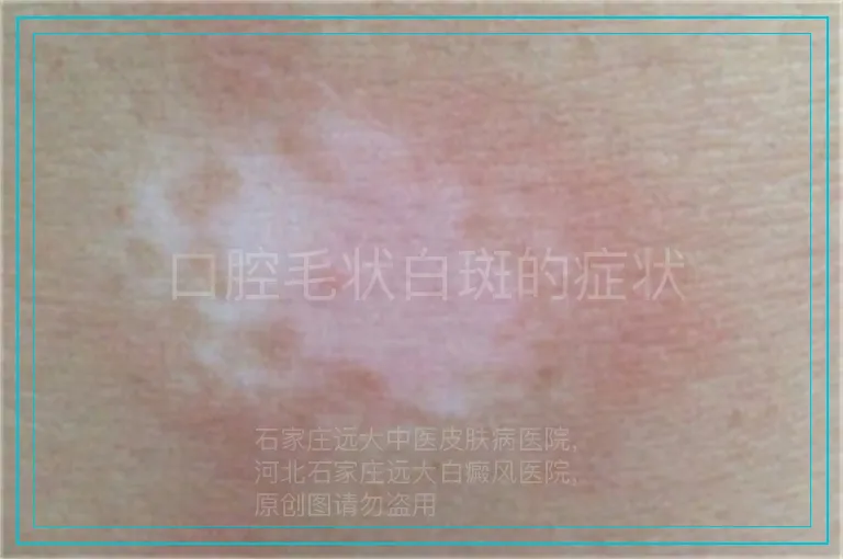 口腔毛状白斑的症状