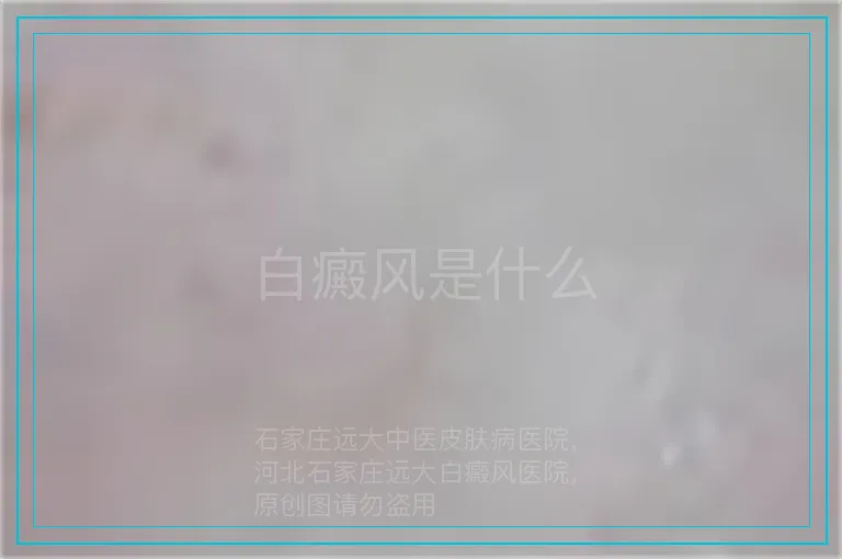 白癜风是什么