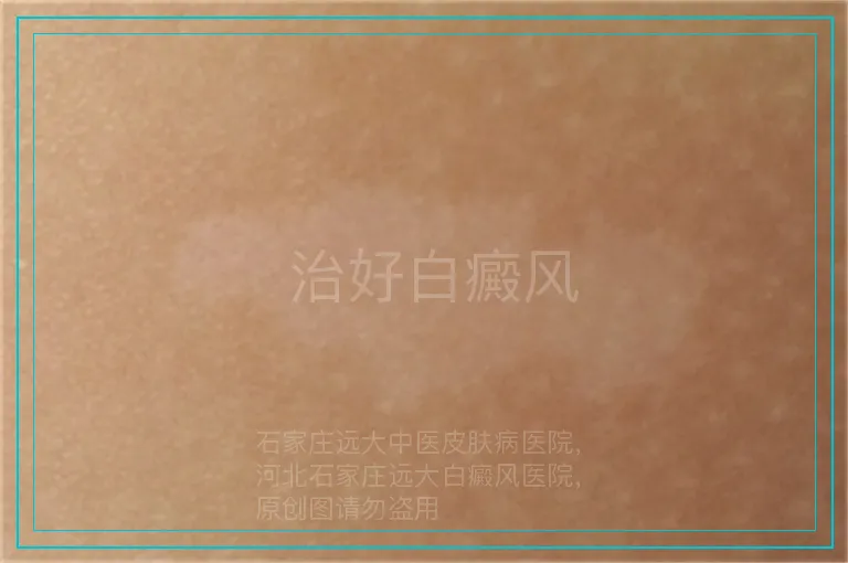  治好白癜风