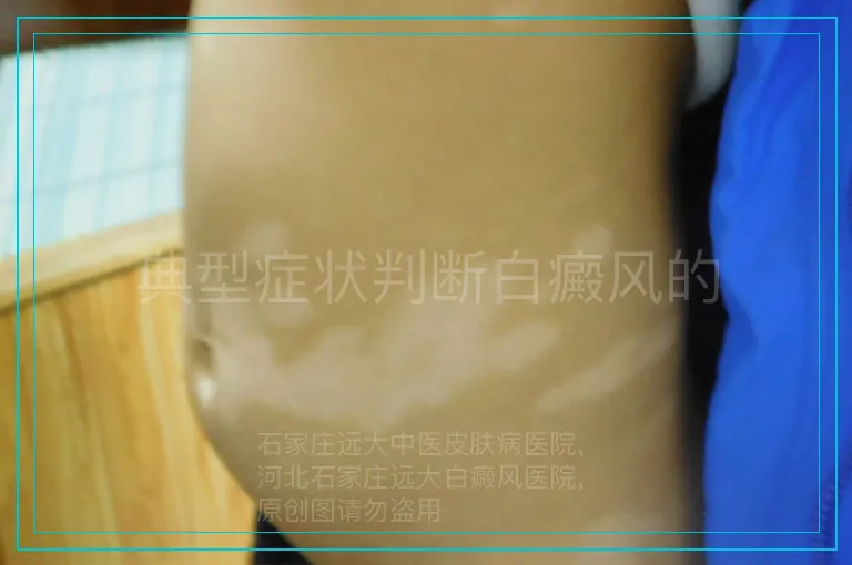 典型症状判断白癜风的