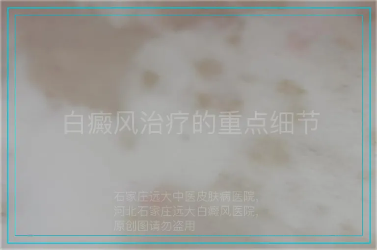 白癜风治疗的重点细节