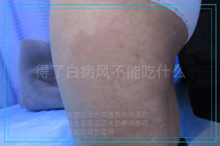 得了白癜风不能吃什么