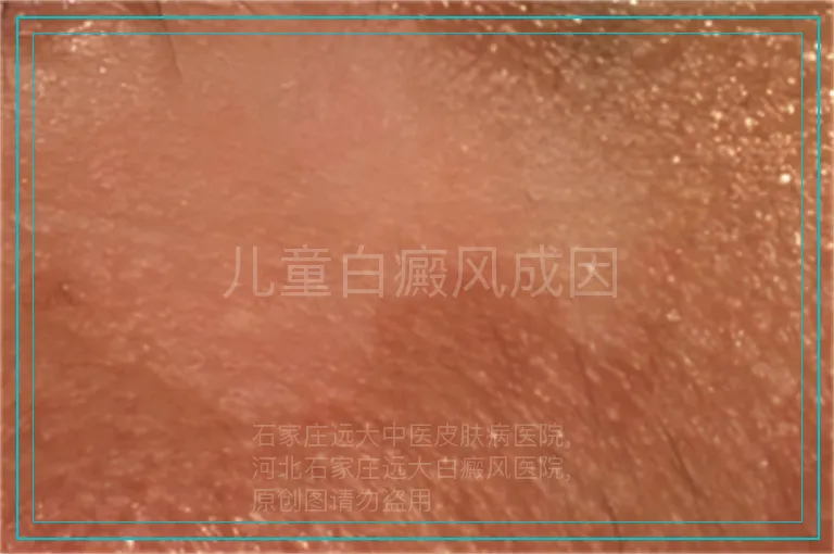儿童白癜风成因