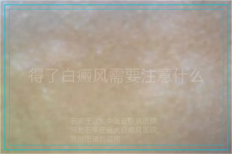 得了白癜风需要注意什么